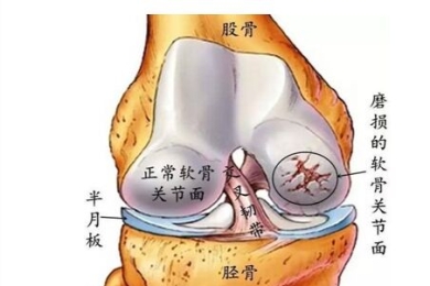 半月板损伤吃氨糖软骨素钙片可修复吗？