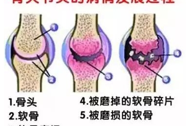 氨糖软骨素钙片需要吃多长时间？不知道的赶紧记下来