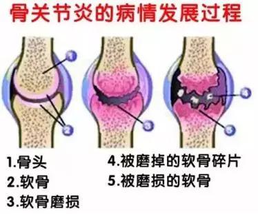 骨关节变过程.jpg