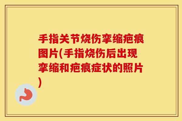 手指关节烧伤挛缩疤痕图片(手指烧伤后出现挛缩和疤痕症状的照片) 手指关节烧伤挛缩疤痕图片(手指烧伤后出现挛缩和疤痕症状的照片)