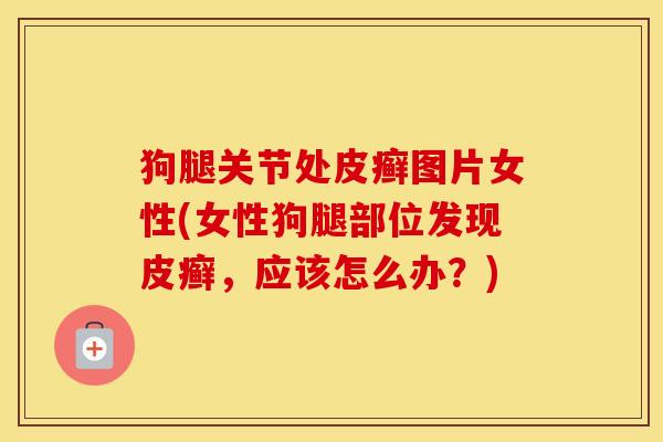 狗腿关节处皮癣图片女性(女性狗腿部位发现皮癣,应该怎么办?) 狗腿关节处皮癣图片女性(女性狗腿部位发现皮癣,应该怎么办?)